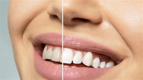Laser Teeth Whitening Procedure Vs Traditional Whitening Manhasset