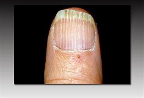 Vitamin d deficiency can result from inadequate exposure to sunlight; Vitamin deficiency fingernails - Awesome Nail