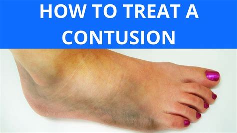 How To Treat A Contusion Youtube