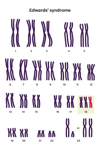 Human Karyotype Of Edward Syndrome Autosomal Abnormalities Trisomy 18 Human Karyotype Of Down