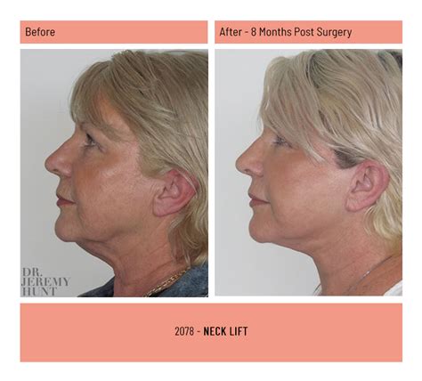 60 Neck Lift Platysmaplasty Before And After Photos Dr Hunt Sydney