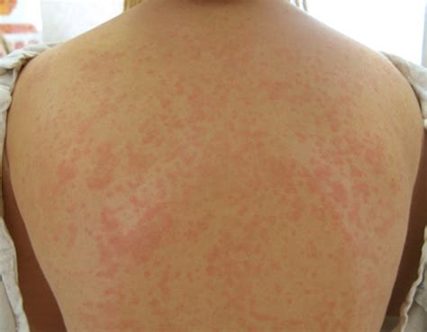 What Causes Red Spots On Chest And Back Macular Rash Definition Best