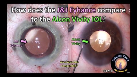 CataractCoach J J Eyhance Compared To The Alcon Vivity IOL YouTube