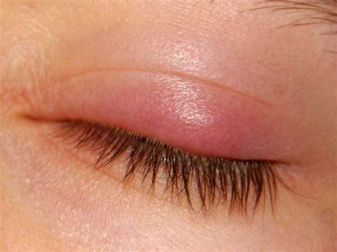 Eyelid Redness Causes Symptoms Inflamed Dry Itchy Swollen Red