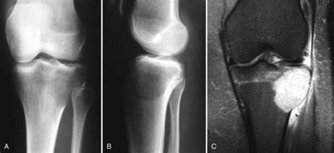 Surgical Treatment Of Benign Bone Lesions Musculoskeletal Key