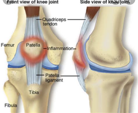 Knee Pain Update Core Omaha Explains C O R E Physical Therapy