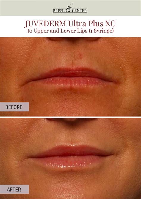 Procedure Juvederm Ultra Plus Xc To Upper And Lower Lips 1 Syringe