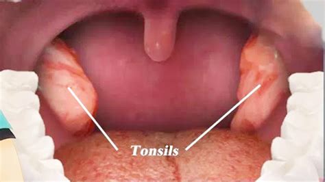 टॉन्सिल्स के लक्षण कारण और घरेलु उपचार Tonsils Ke Lakshan Karnd Aur