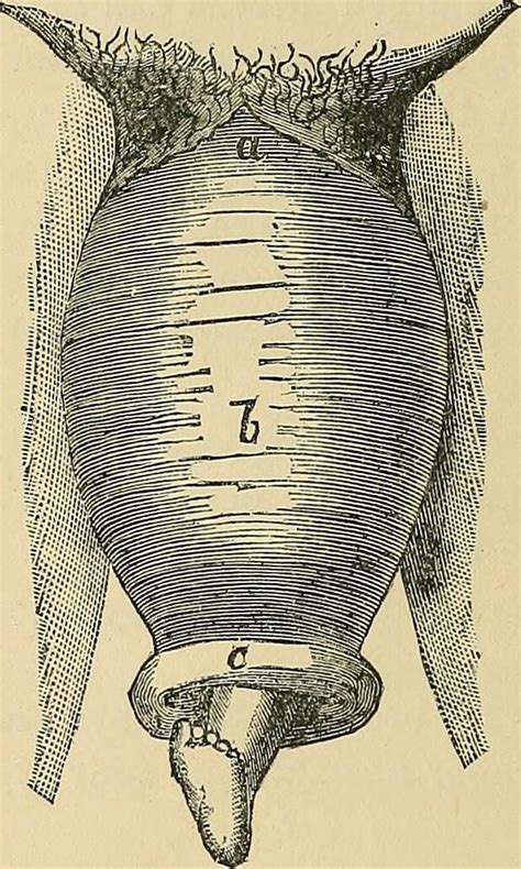 Uterine Prolapse