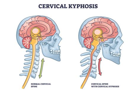 Sunset Chiropractic And Wellness Review Incidence Of Cervical Kyphosis