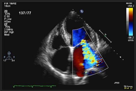 Normal Anatomical Variants In Echocardiogram Echocard