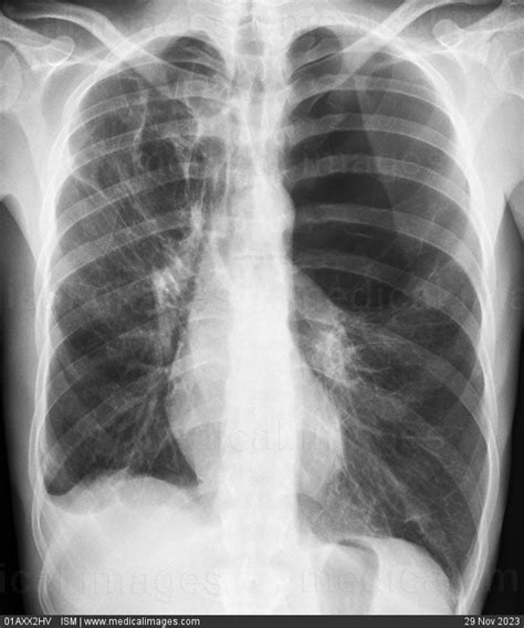 Stock Image Large Bullous Emphysema Of The Left Lung Chest X Ray Of A