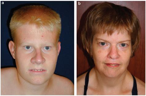 Prader Willi Syndrome Symptoms Causes Complications Pictures