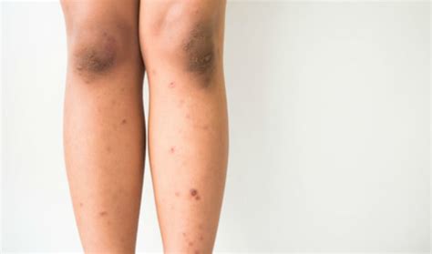 Brown Spots On Legs