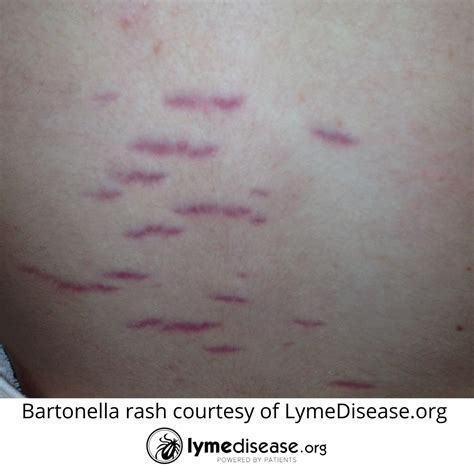 How Prevalent Is Bartonella In People Who Have Lyme Disease