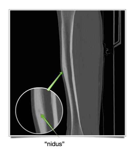 Benign Bone Tumors — Sarcoma Specialists