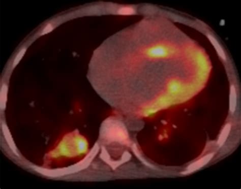 Possible Infective Endocarditis Confirmed By Pet Ct Eurorad