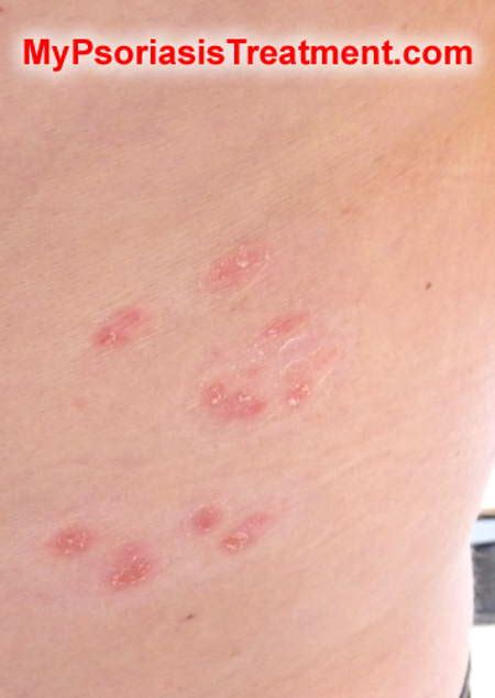 Liver Eczema Psoriasis Vs Ringworm Scalp Kentucky Louisville 34248