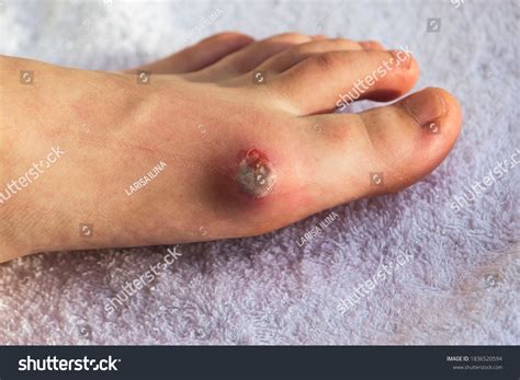 Diabetes Mellitus Foot Infected Wound Treatment Stock Photo Edit Now