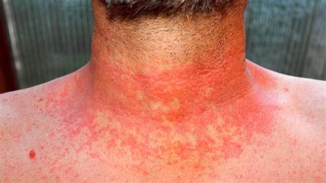 Autoimmune Skin Diseases And Rashes That Affect Appearance Everyday