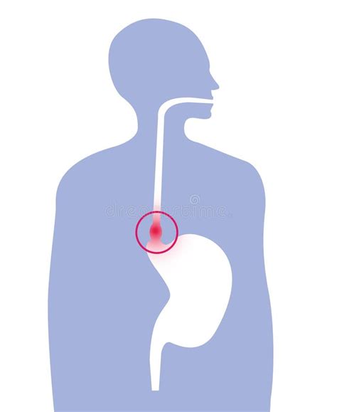 Hiatus Hernia Stock Vector Illustration Of Organ Digestion 26464706