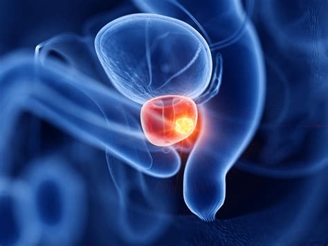 Cancer De La Prostate Symptômes Traitement à Quel âge