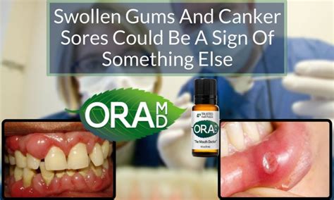 Swollen Gums And Canker Sores Could Be A Sign Of Something Else Oramd