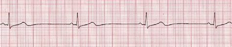 Sinus Rhythms Medictests