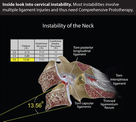 Post Traumatic Instability Of The Cervical Spine
