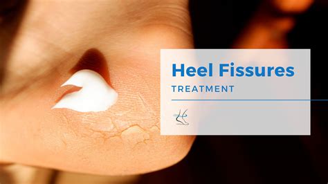 Cosmetic Heel Fissure Treatment Moore Foot And Ankle Specialists