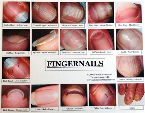 1 Fingernail With Disorder Nail Health Signs Fingernail Health