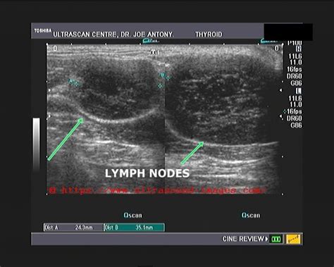 You may therefore develop lots of large cancerous lymph nodes and an enlarged spleen. A Gallery of High-Resolution, Ultrasound, Color Doppler ...