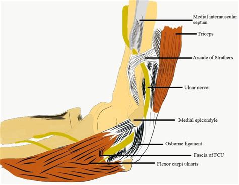 Ulnar Nerve Entrapment Sites Around Elbow Download Scientific Diagram