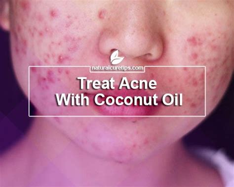 Treat Acne With Coconut Oil Coconut Oil For Acne Coconut Oil For