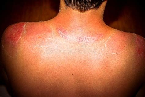 Close Up Detail Of A Very Bad Sunburn Back Mans Stock Photo Image