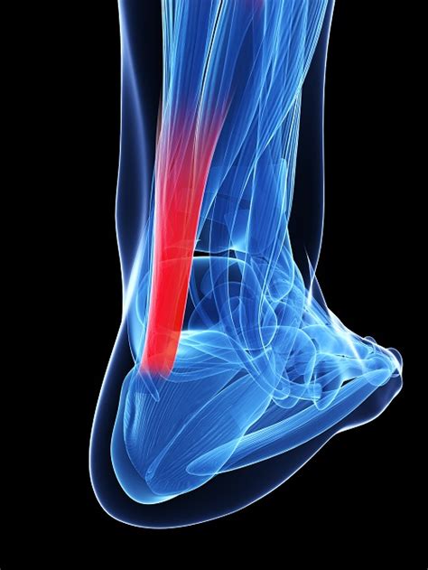 Achilles Tendinitis Is Common And Can Be Difficult To Get Rid Of