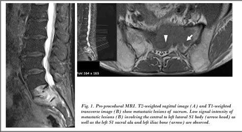 Figure 1 From Percutaneous Sacroplasty Under Fluoroscopic Guidance