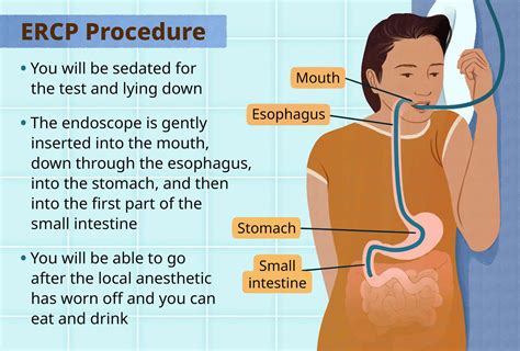 Ercp Procedure Digestion Diagnosis Treatment Results