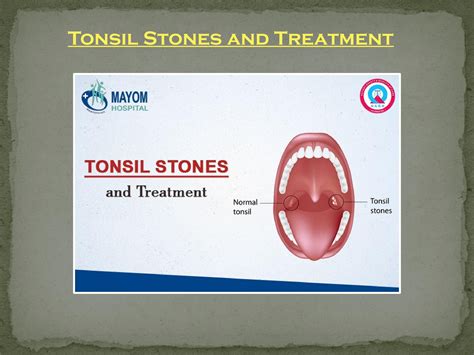 Tonsil Stones And Treatment Ent Treatment In Gurgaon By Healthcare