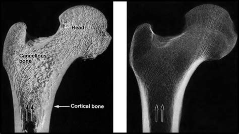 Bone Section Left And Radiograph Right Of The Proximal Femur In The