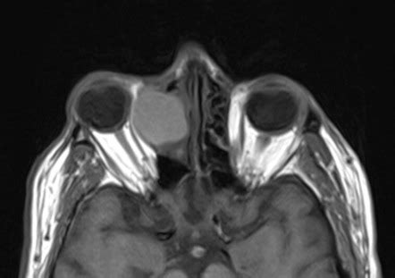 Ethmoid Mucocele Radiology Reference Article Radiopaedia Org