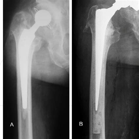 A The Extended Trochanteric Osteotomy Is Performed By Cutting From