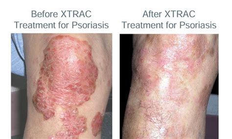 What Causes Psoriasis And Is It Contagious Your Great Skin