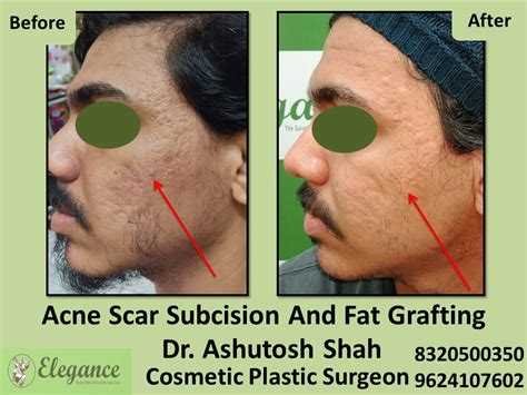 Acne Scar Subcision Fat Grafting Treatment In Udhna Surat
