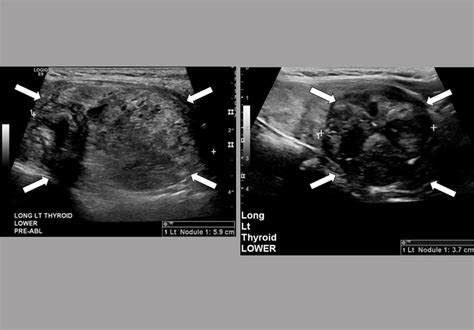 Radiofrequency Ablation Therapy For Large Benign Thyroid Nodules Mayo