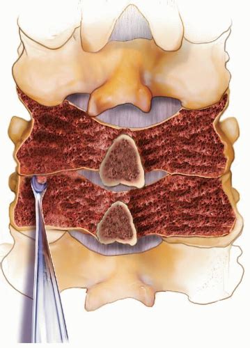 Posterior Cervical Fusion With Instrumentation Musculoskeletal Key