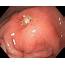 Prepyloric Stomach Ulcer Endoscopic View  Stock Image C033/9777