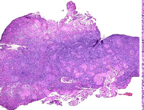 Figure 2 From Invasive Keratinizing Squamous Cell Carcinoma Of The Left