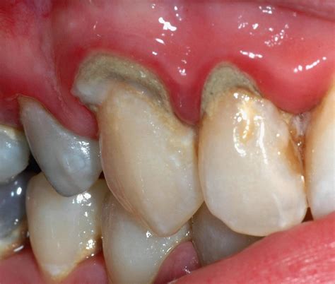 Periodontics Gum Infections Linked To Several Cancers In Women