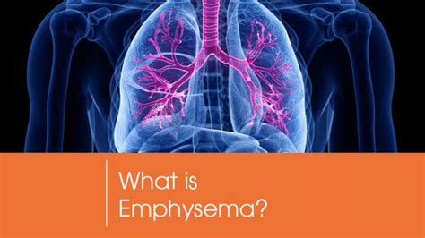 What Is Emphysema An Introduction To Emphysema